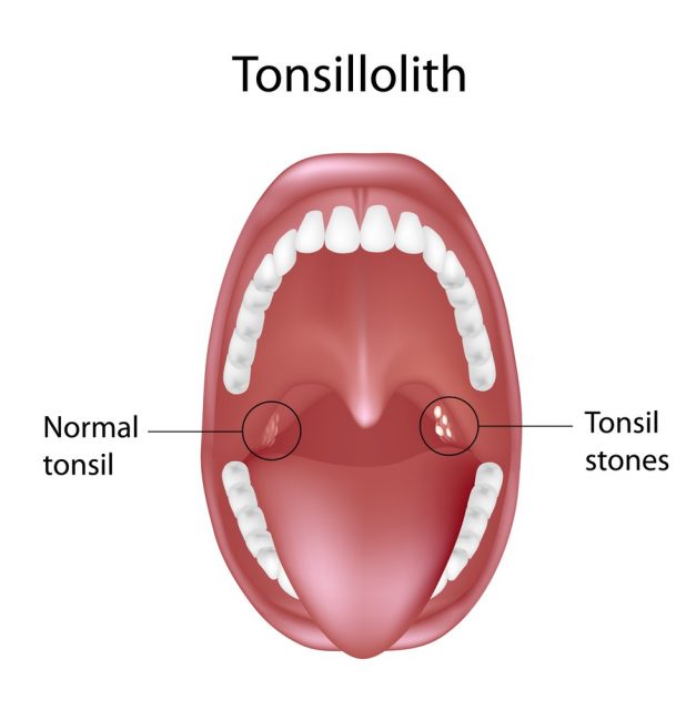 White Spots On Tonsils Causes Symptoms Treatment Pictures