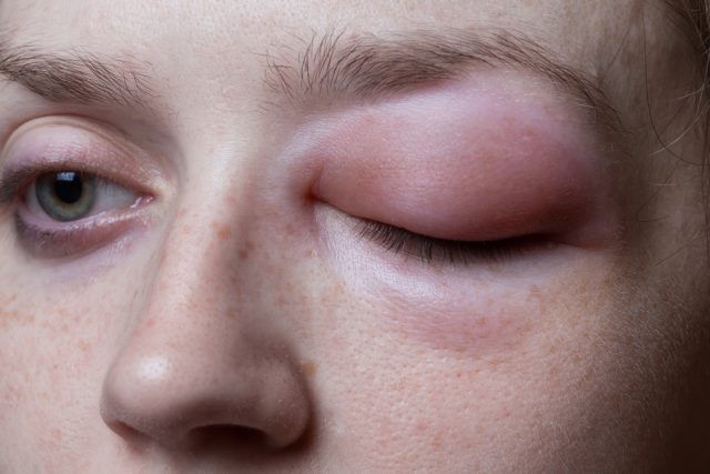 33 What Kind Of Allergy Causes Swollen Eyes Allergies