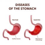 Stomach Polyps: Symptoms, Causes, Diet, Treatment | STD.GOV Blog