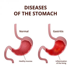 Stomach Polyps: Symptoms, Causes, Diet, Treatment | STD.GOV Blog