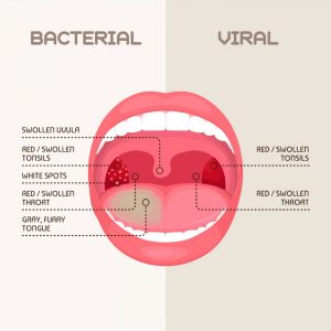 Chronic Pharyngitis: Symptoms, Causes, Home Remedies | STD.GOV Blog