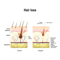 What Causes Bald Patches On The Scalp? | STD.GOV Blog