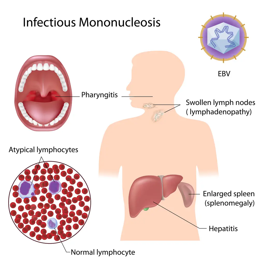 epstein-barr-virus-types-symptoms-treatment-home-remedies-std-gov