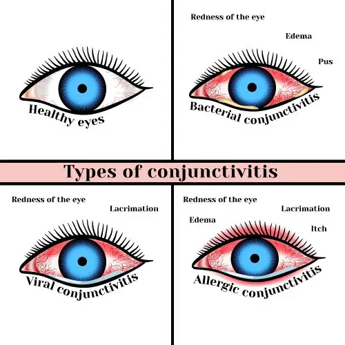 Viral Eye Infection: Types, Symptoms, Treatment | STD.GOV Blog