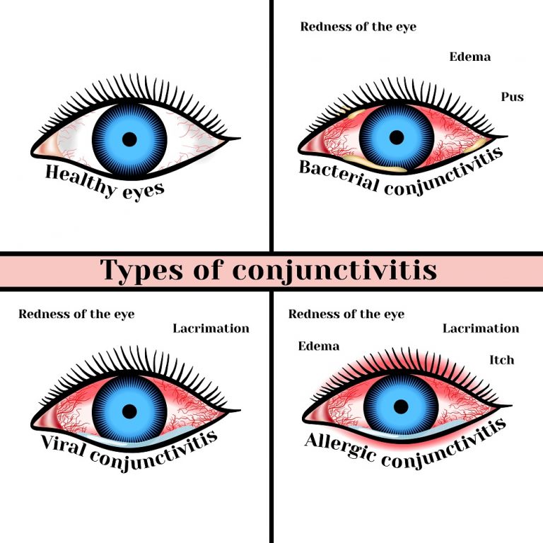 Viral Eye Infection Types Symptoms Treatment Stdgov Blog 