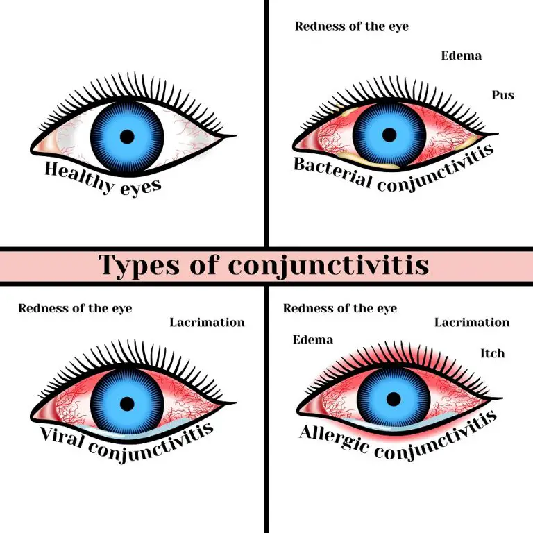 Viral Eye Infection Types Symptoms Treatment STD GOV Blog