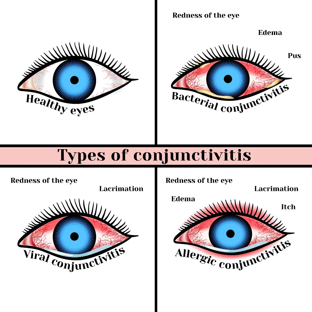 Viral Eye Infection Types Symptoms Treatment STD GOV Blog