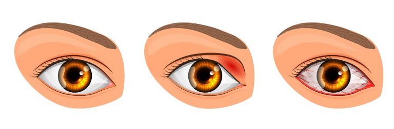 Viral Eye Infection Types Symptoms Treatment Stdgov Blog 4988