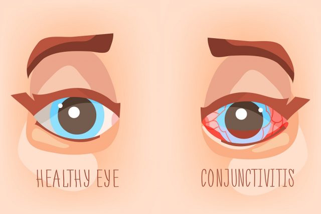 Viral Eye Infection Types Symptoms Treatment STD GOV Blog