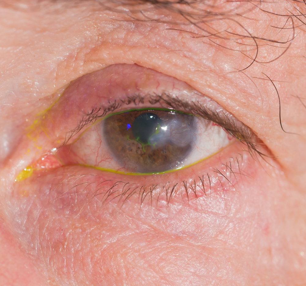 Viral Eye Infection: Types, Symptoms, Treatment | STD.GOV Blog