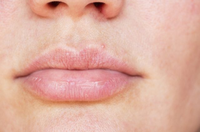 Causes Of The White Bumps On Lips STD GOV Blog