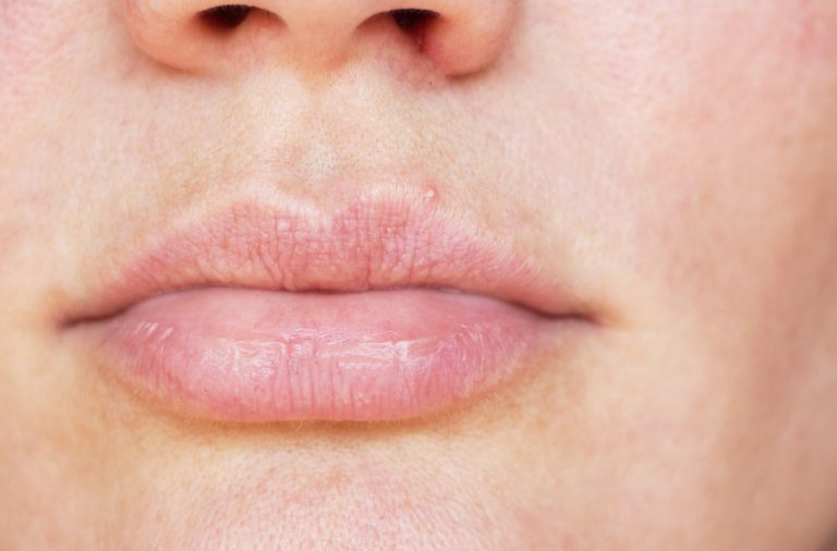 bumps-on-lips-causes-treatments-and-more