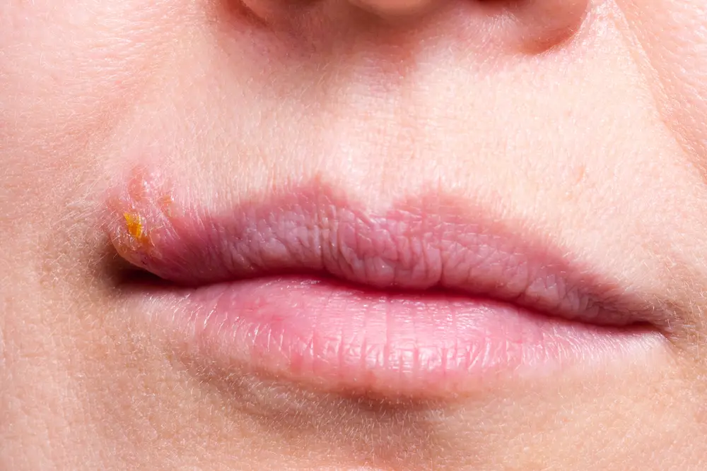 Causes Of The White Bumps On Lips STD GOV Blog