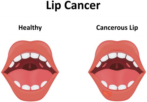 causes-of-the-white-bumps-on-lips-std-gov-blog