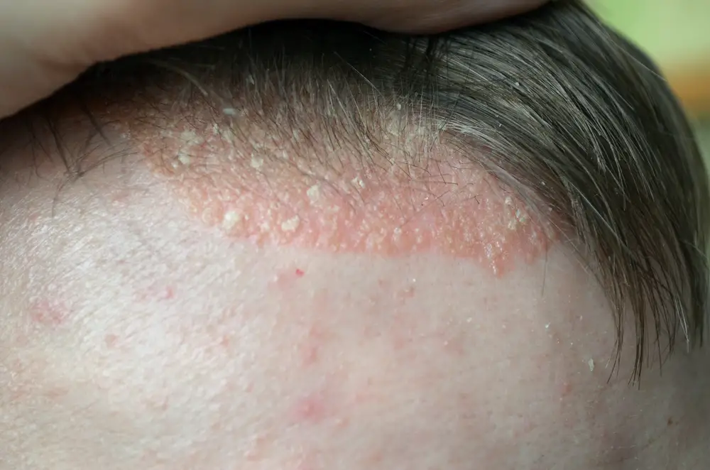 What Causes Bald Patches On The Scalp STD GOV Blog