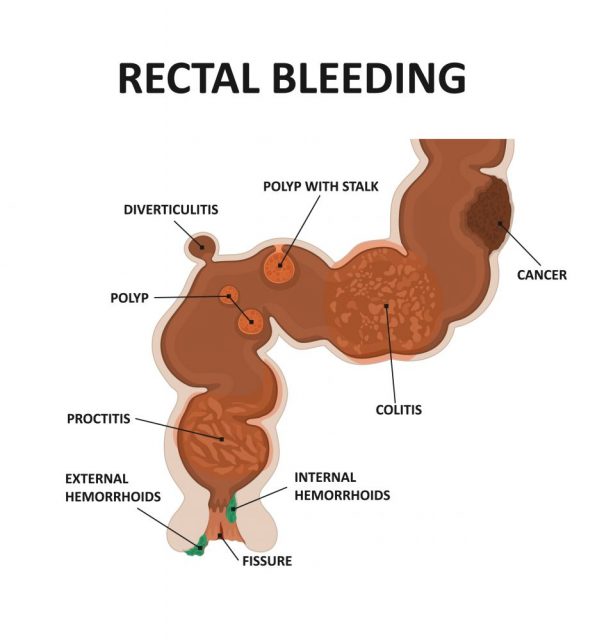 Causes Of Blood In Stool STD GOV Blog