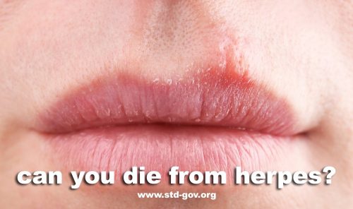 can-you-die-from-herpes-std-gov-blog