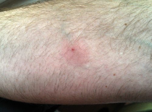 Ant Bites Pictures Treatment Home Remedies Symptoms   Ant Bites5 500x367 