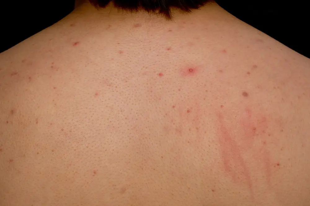 Back Acne Causes Types How To Get Rid Scar Treatments