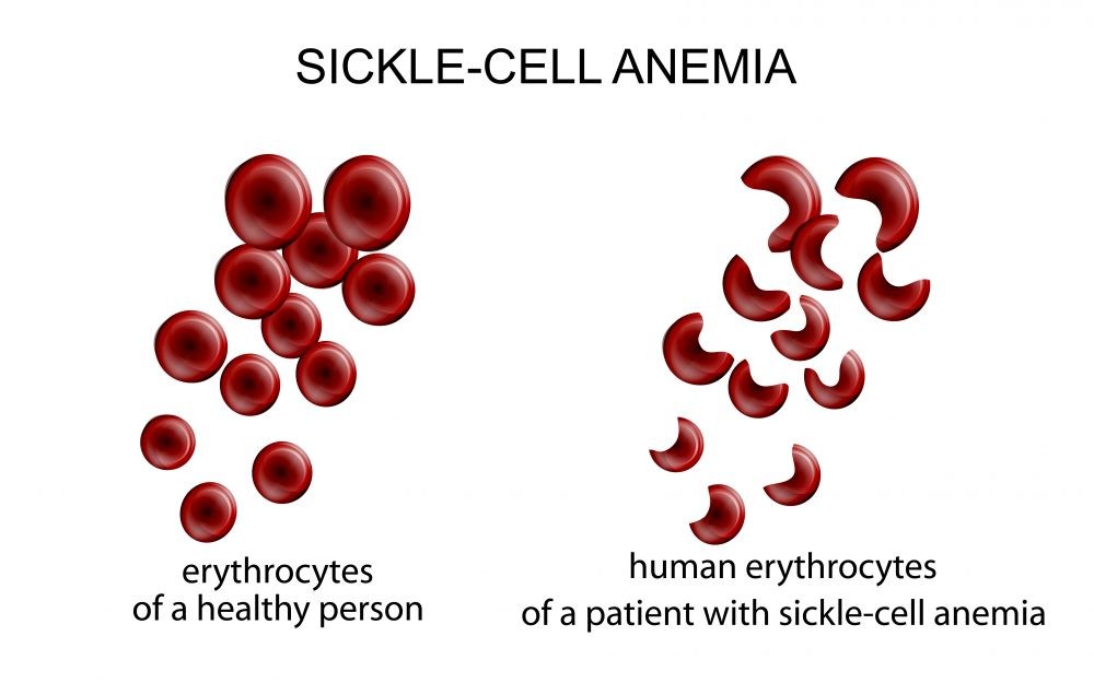 Can You Die From Anemia Std Gov Blog