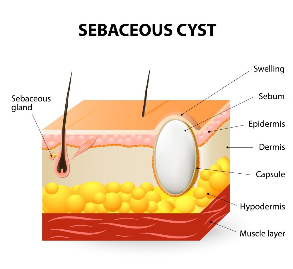 Cyst Removal Causes Diagnosis Treatment Options Pictures