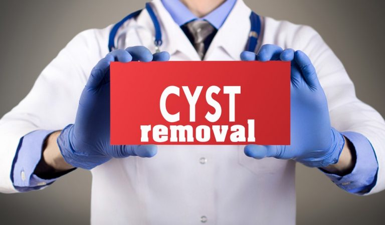 Cyst Removal 