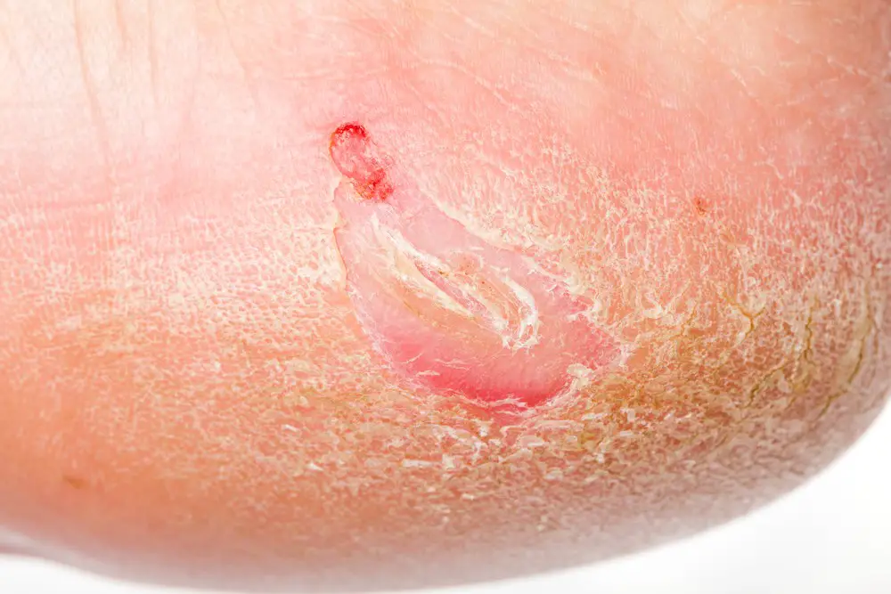 Dry Skin On Feet Causes Symptoms Home Remedies Treatment Pictures