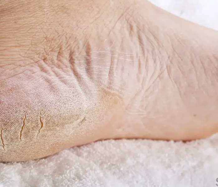 Dry Skin On Feet Causes Symptoms Home Remedies Treatment Pictures