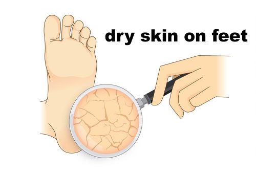 dry-skin-on-feet-causes-symptoms-home-remedies-treatment-pictures