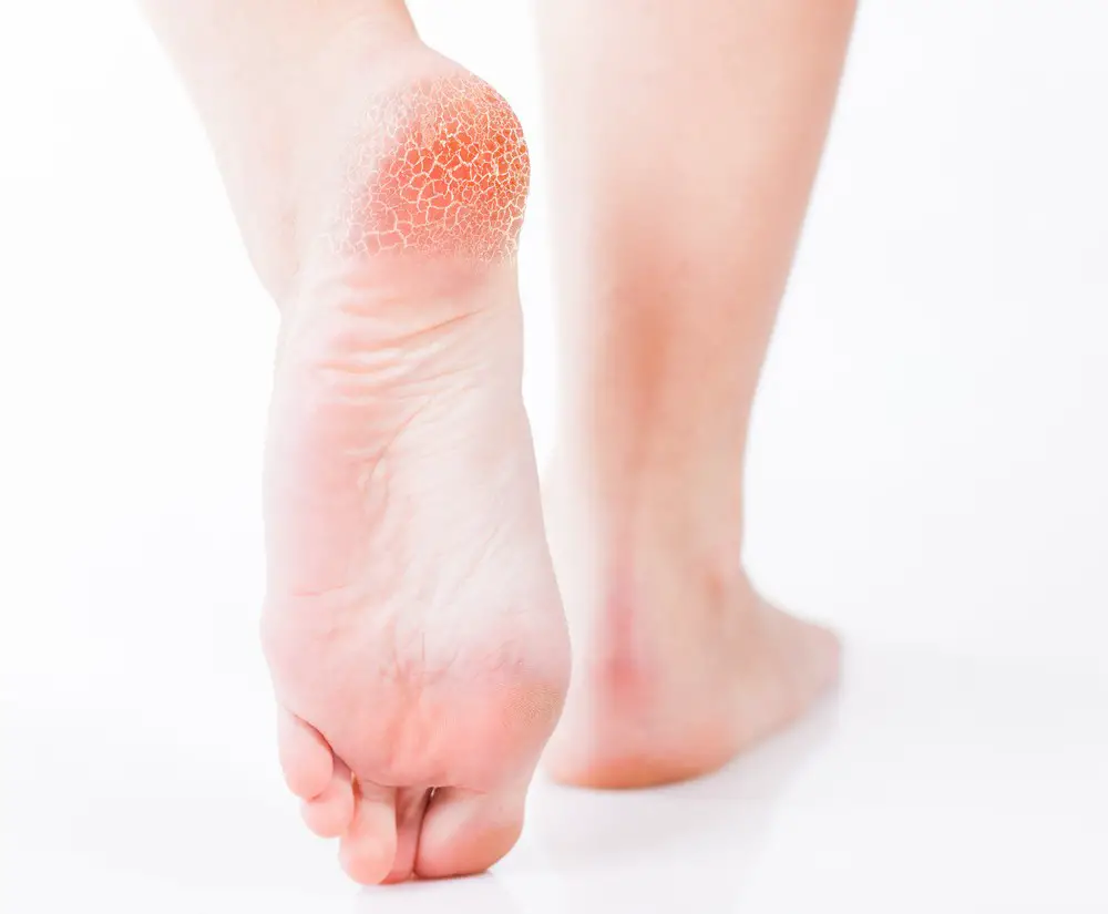 Dry Skin On Feet Causes Symptoms Home Remedies Treatment Pictures