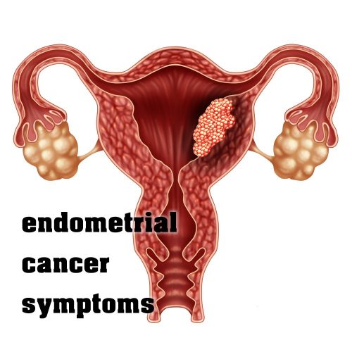 Endometrial Cancer Symptoms Risk Factors Stages Treatment