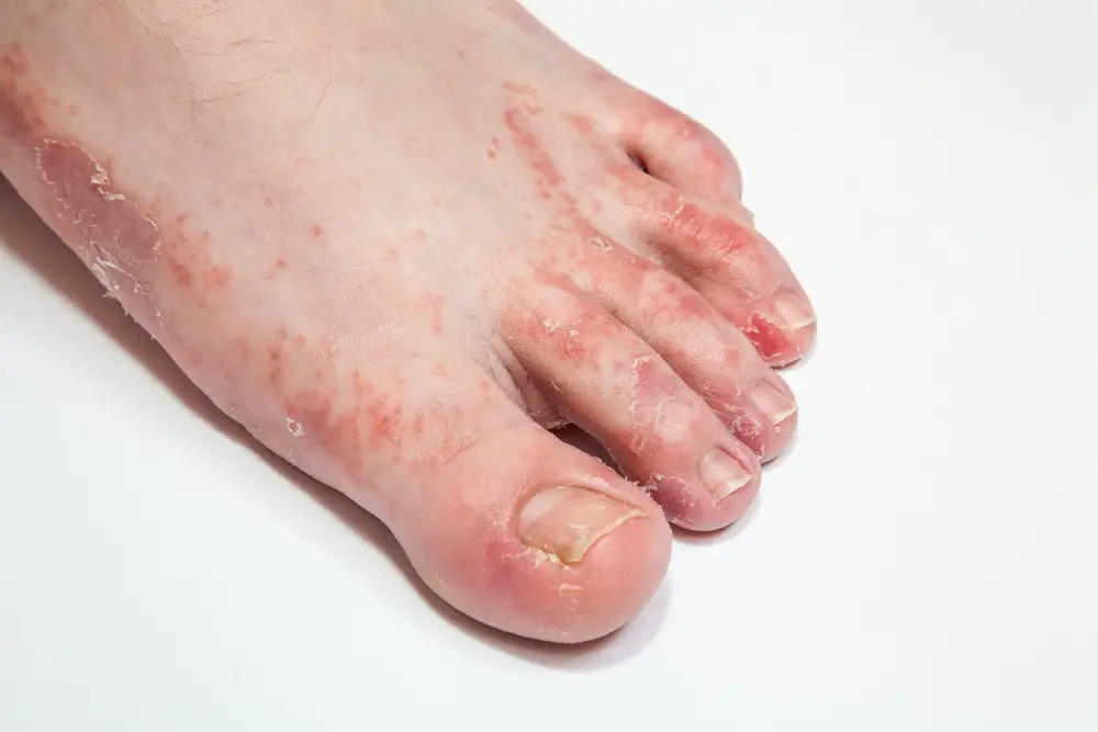 Foot Rash Causes Symptoms Home Remedies Treatment Pictures