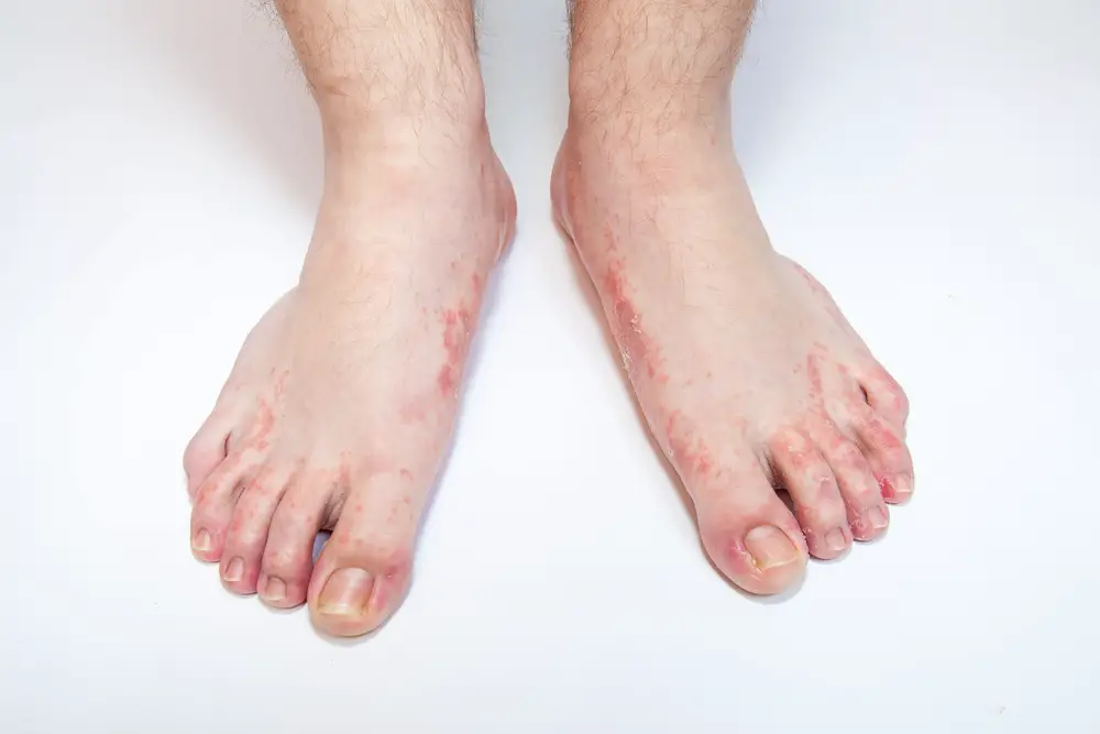 Foot Rash Causes Symptoms Home Remedies Treatment Pictures