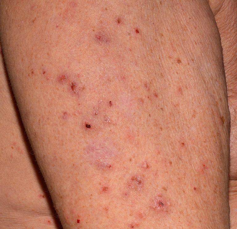 How Do You Get Scabies Causes Symptoms Treatment Pictures 6637