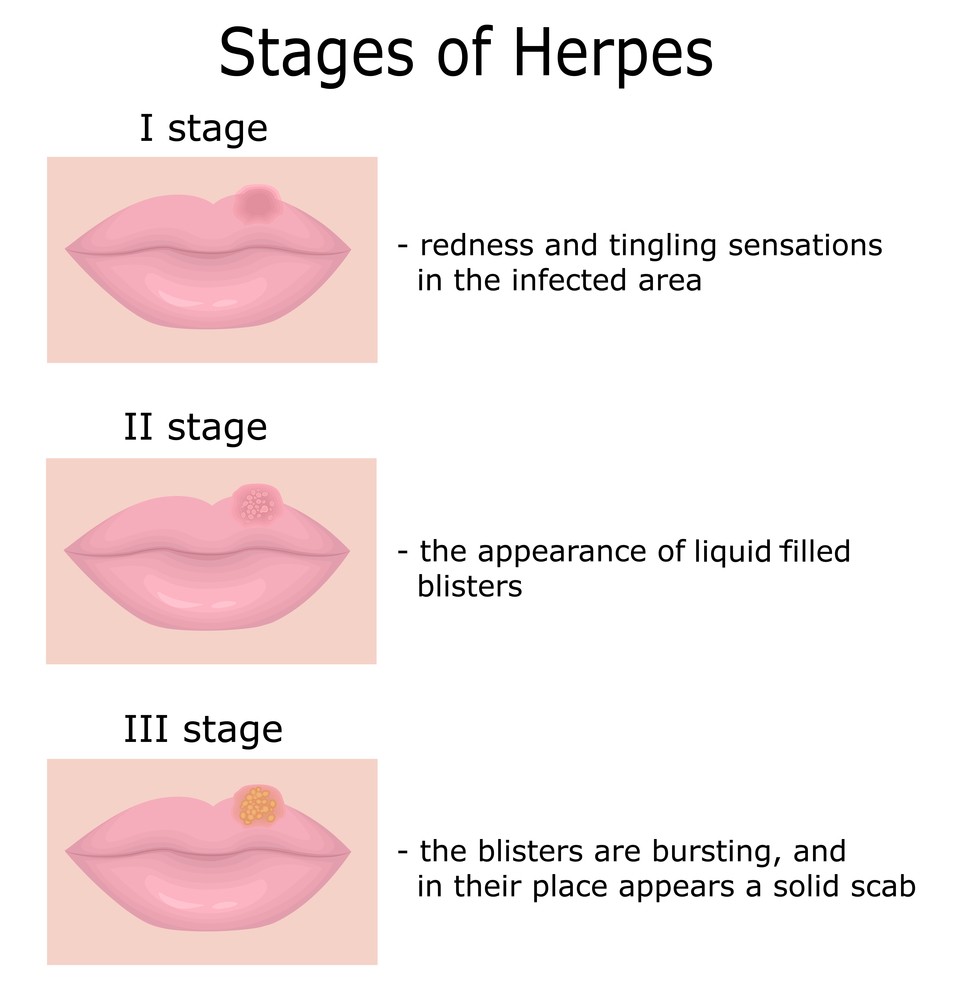herpes dating in chicago reddit cure