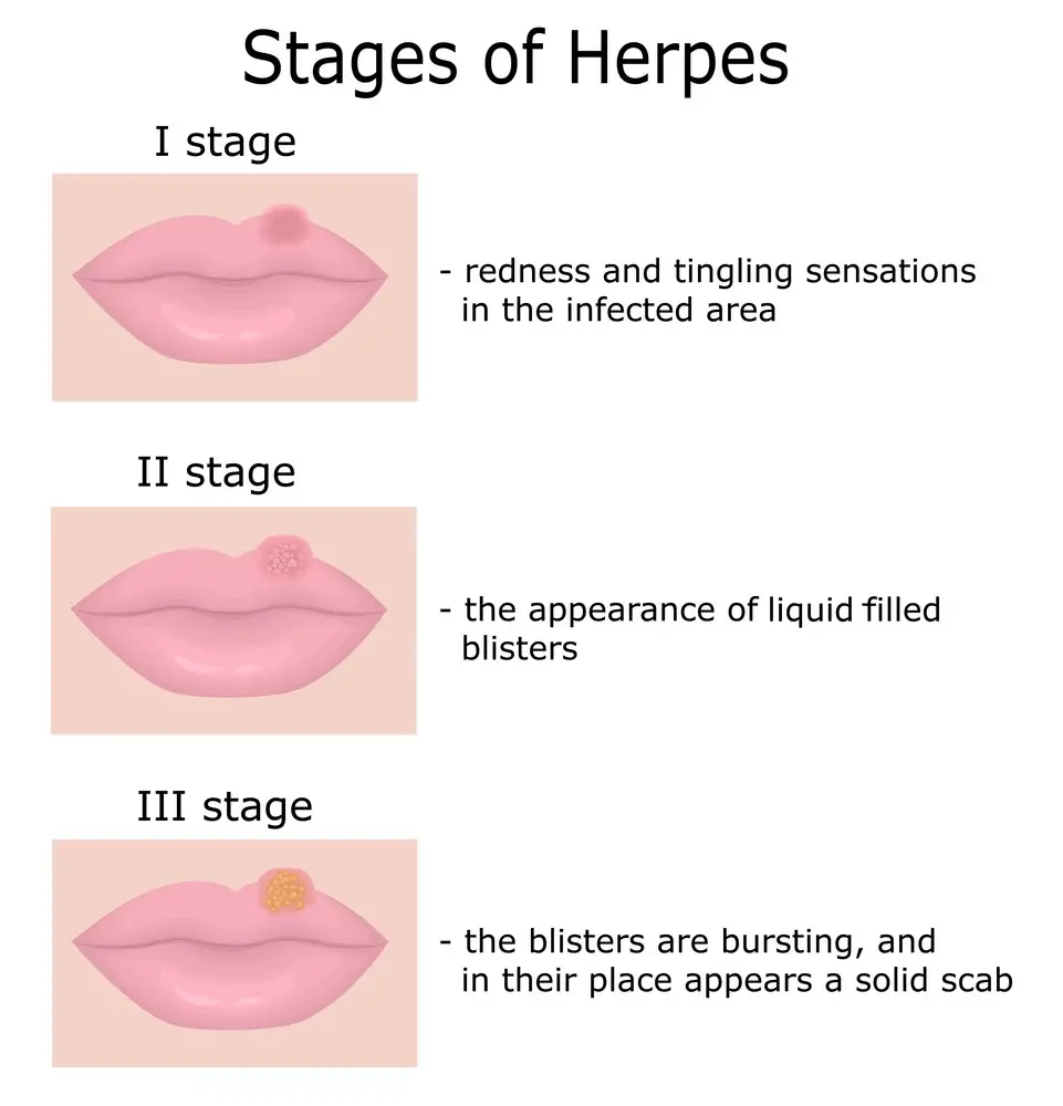 Living With Herpes Causes Symptoms How To Deal With Herpes 