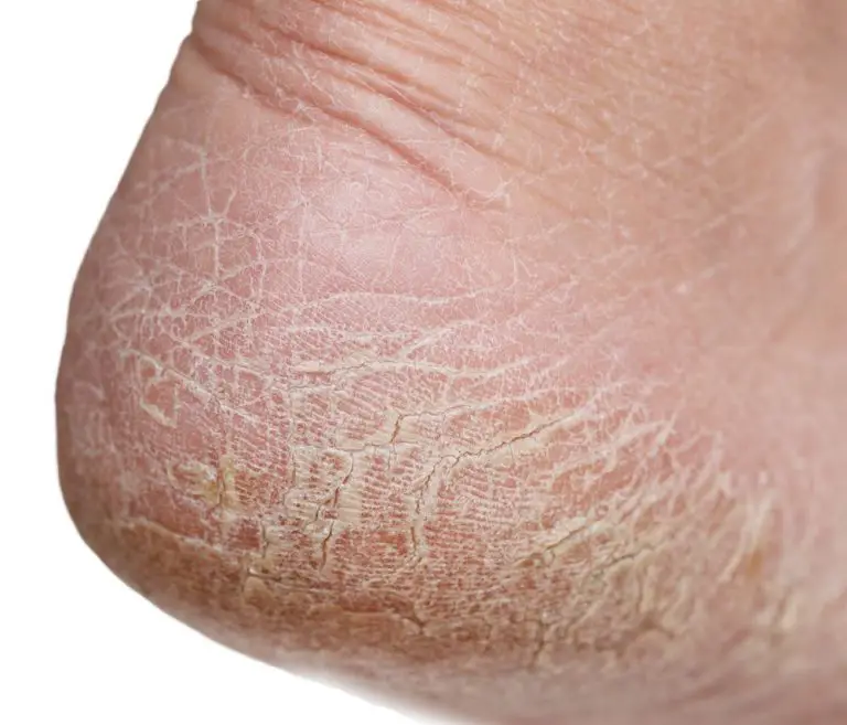 Peeling Feet causes, symptoms, home remedies, pictures