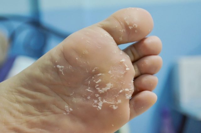 Peeling Feet Causes Symptoms Home Remedies Pictures