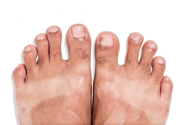 peeling-feet-causes-symptoms-home-remedies-pictures