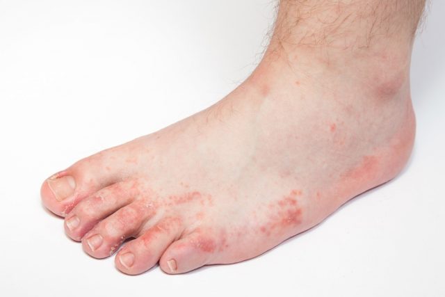 Peeling Feet Causes Symptoms Home Remedies Pictures