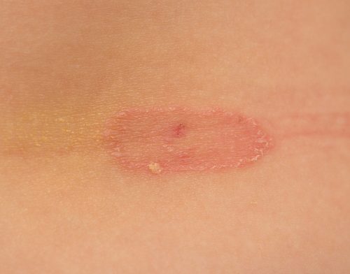 Ringworm pictures | causes & symptoms, how does it look like?