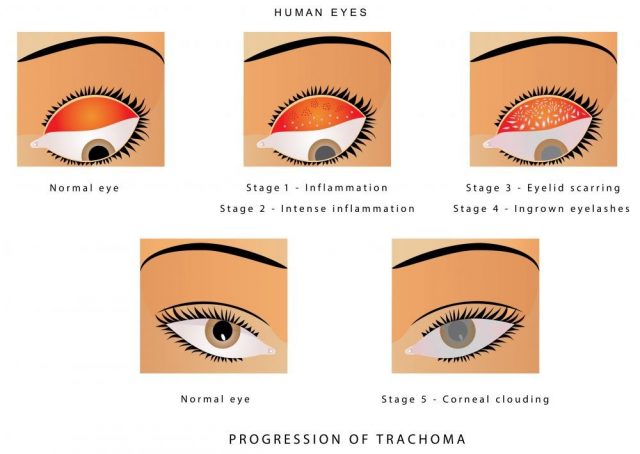 Trachoma of the eye. Progression of trachoma. Trachoma, an infection of the eye caused by Chlamydia trachomatis. Trachoma is a bacterial infection that affects your eyes