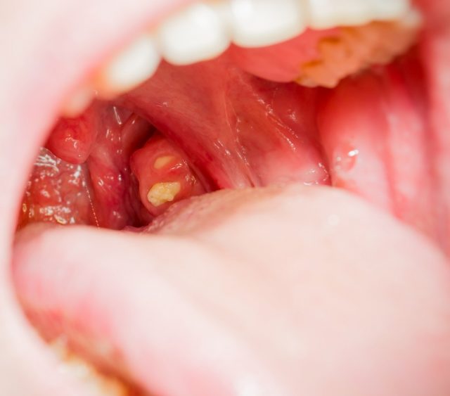 white-spots-on-tonsils-causes-symptoms-treatment-pictures