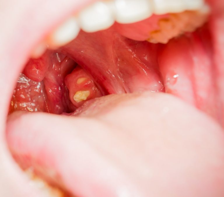 White Spots On Tonsils Symptoms Causes And Treatments Viewhealthy 