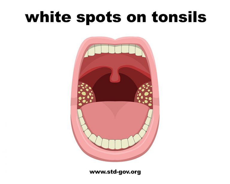 White Spots On Tonsils 768x614 
