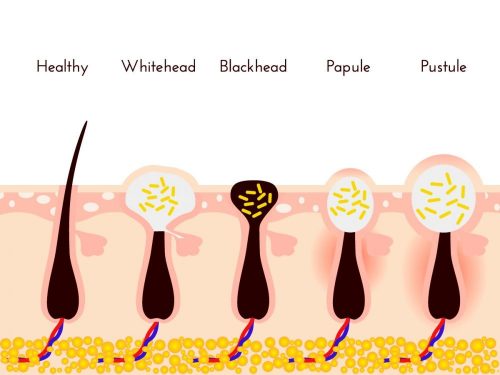 whiteheads-causes-preventions-treatments-home-remedies