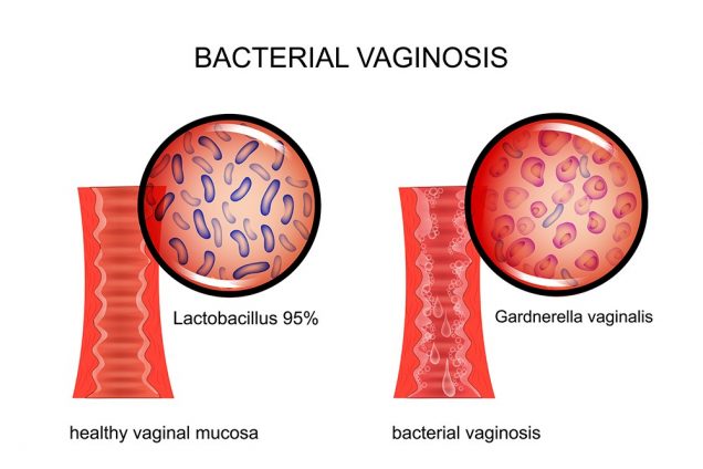 Bacterial Vaginosis Bv Symptoms Treatment Testing Causes