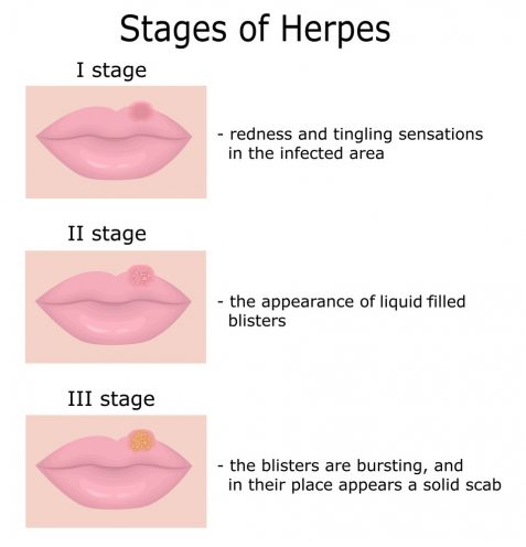 Herpes Herpes Simplex Symptoms Treatment STD Herpes   Stages Of Herpes 477x496 